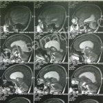 تومور پینه آل