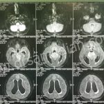 جراحی تومور پینه آل