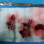 جراحی غده صنوبری