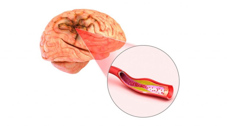 آنوریسم مغزی