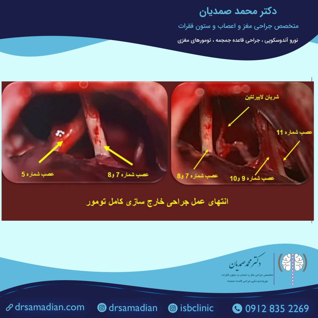 بعد از تومور اپیدرموئید
