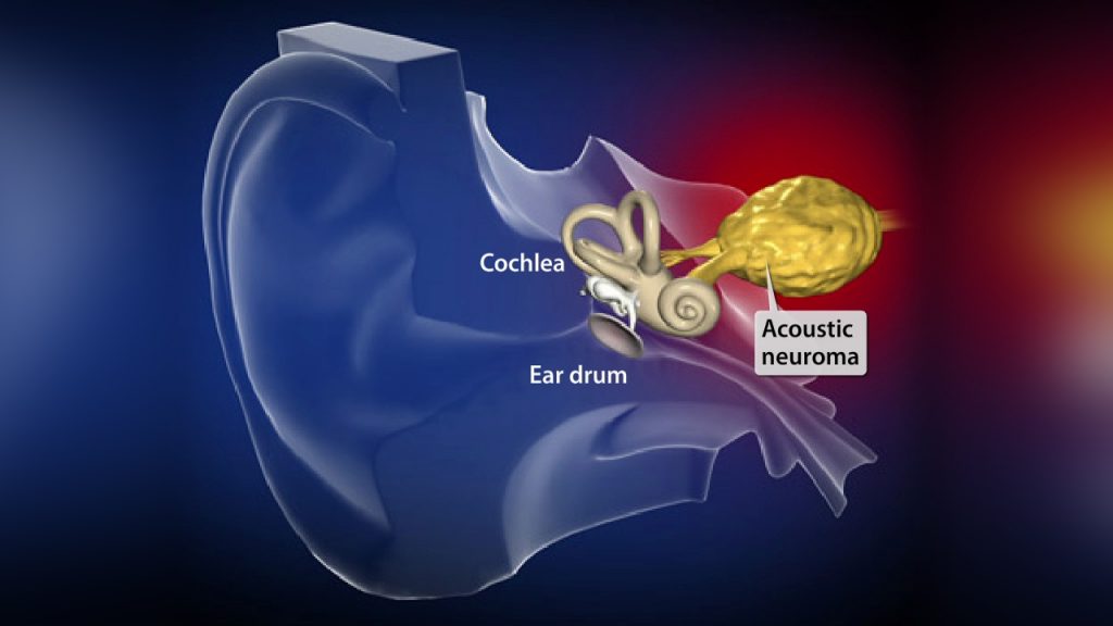 تومور عصب شنوایی