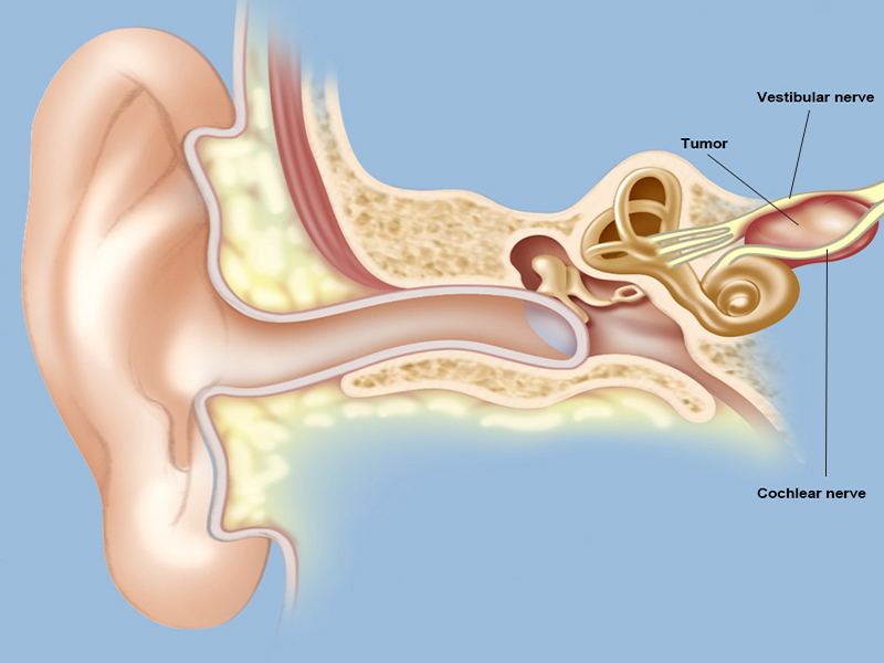 درمان تومور عصب شنوایی