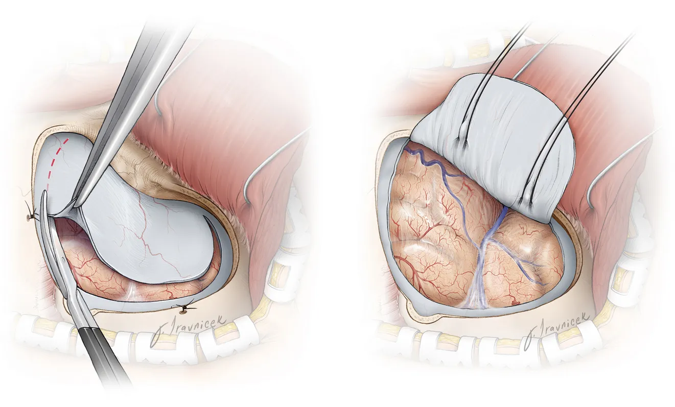 انواع جراحی کرانیوتومی

