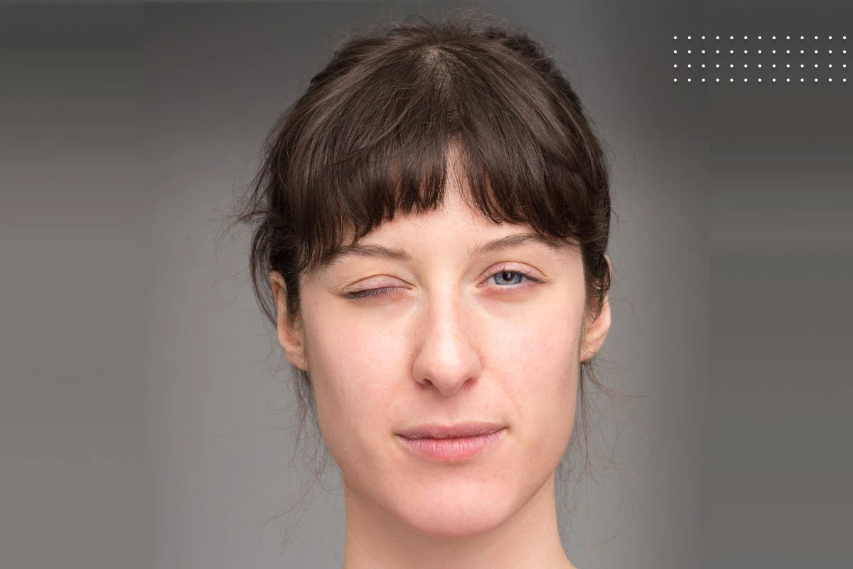 همی فاسیال اسپاسم