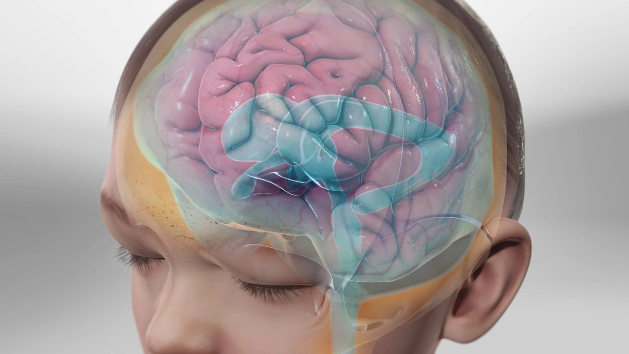 هیدروسفالی