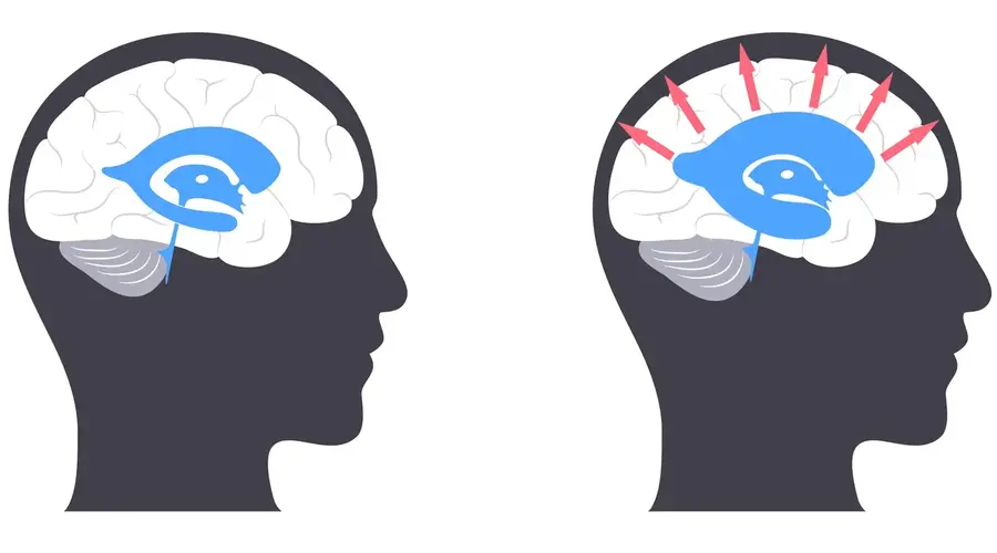 هیدروسفالی