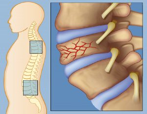شکستگی مهره های کمر