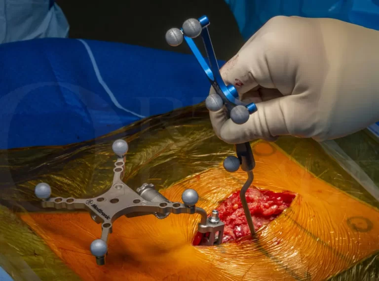 جراحی فیوژن ستون فقرات