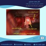 مننژیوم قاعده جمجمه ( توبرکولوم سلا )