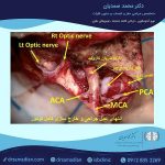 مننژیوم کلینوئیدال2