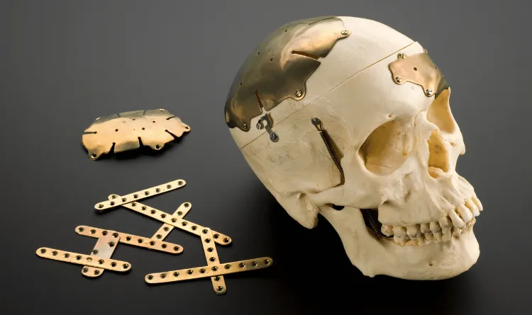 جراحی پروتز جمجمه