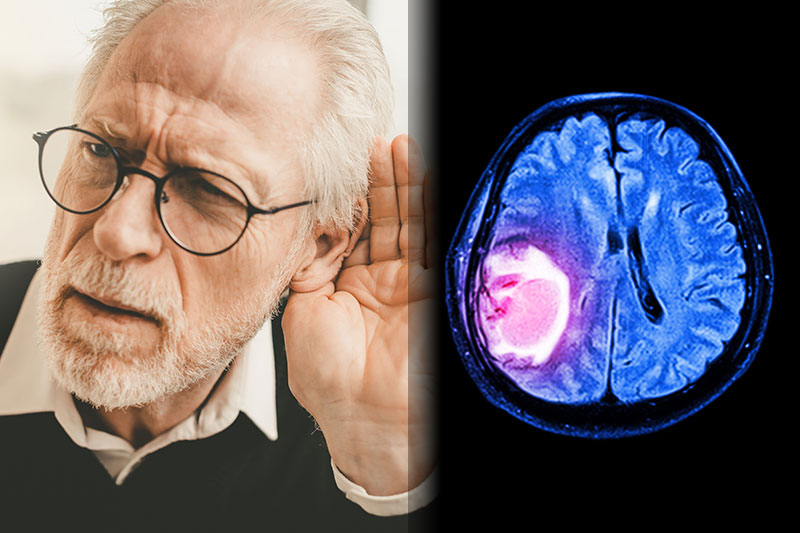 کاهش شنوایی از نشانه های خاموش تومور مغزی