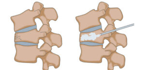 ورتبروپلاستی