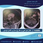 جراحی تومور ساقه مغز