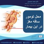 محل تومور ساقه مغز
