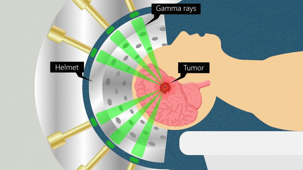 گاما نایف برای درمان قطعی تومور مغزی