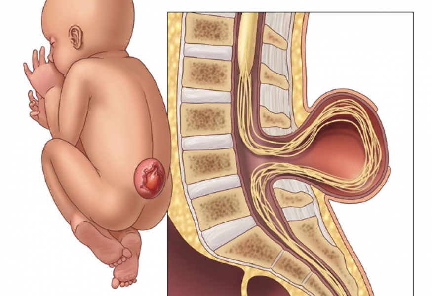 ناهنجاری مادرزادی شکاف در نخاع (میلومننگوسل و اسپینا بیفیدا)