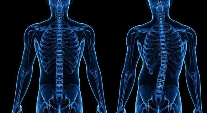 ورزش مناسب انحراف ستون فقرات