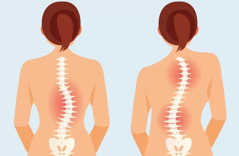 علائم اسکولیوز