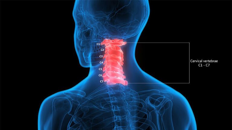 آرتروز گردن