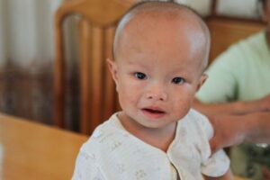 هیدروسفالی