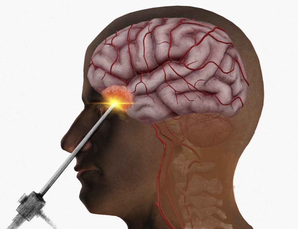 جراحی مغز از طریق بینی