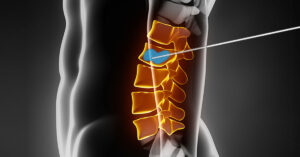 کیفوپلاستی