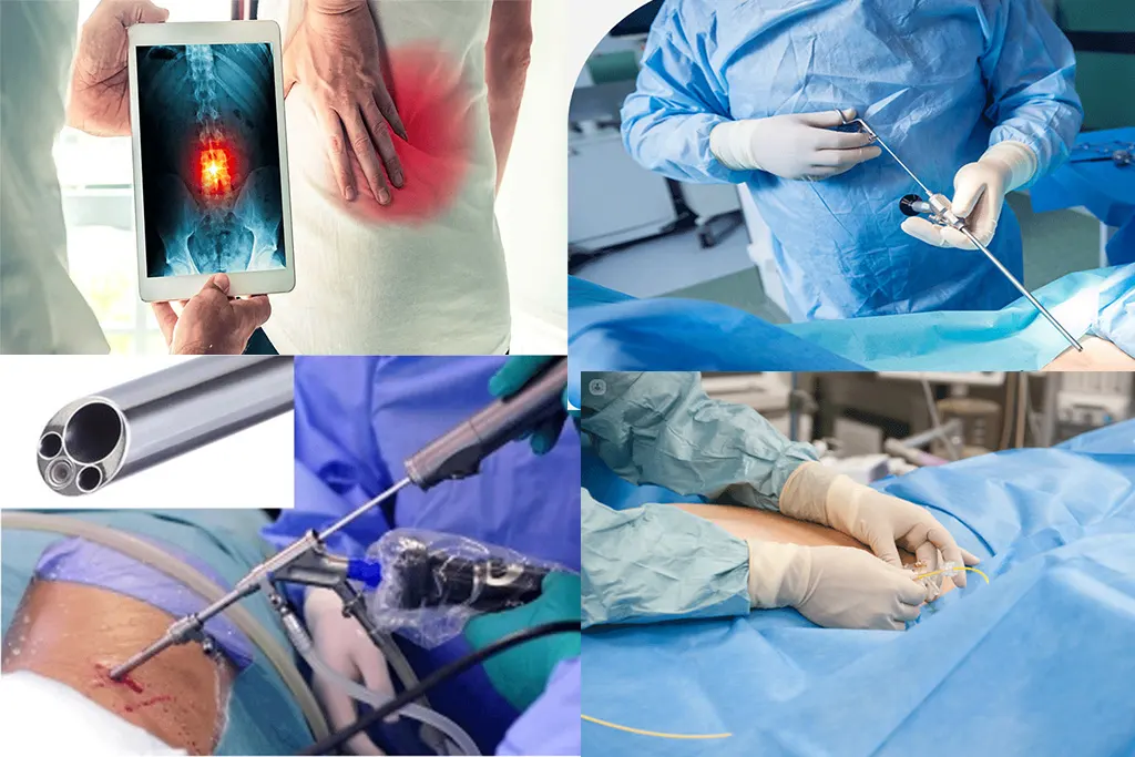 انواع جراحی دیسک کمر