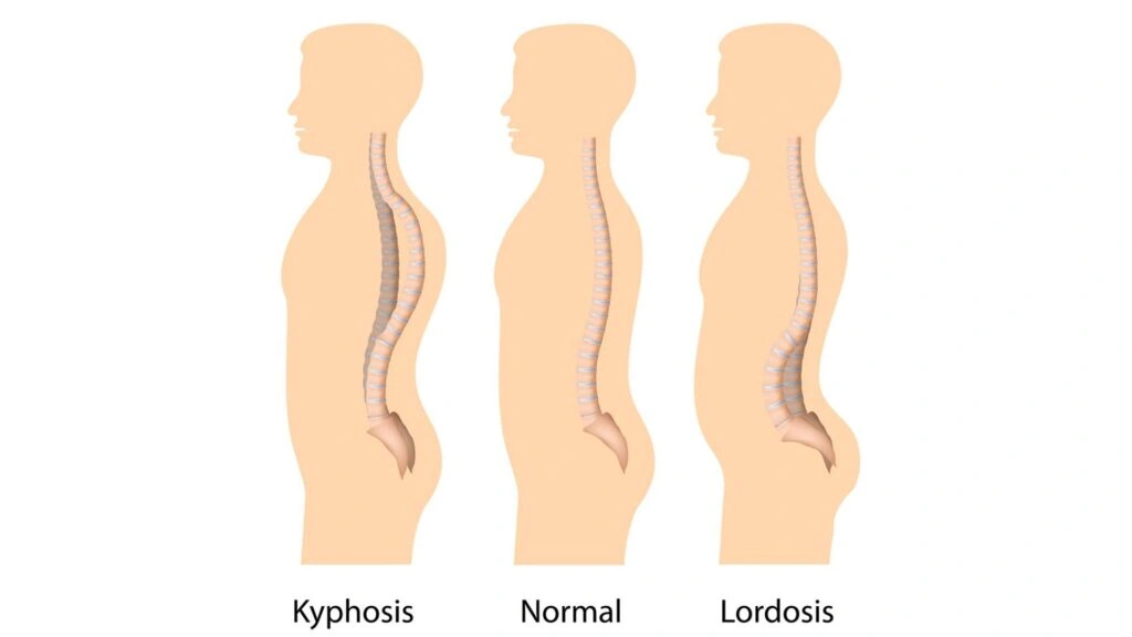 جراحی اصلاح انحراف ستون فقرات (اسکولیوز یا کیفوز)
